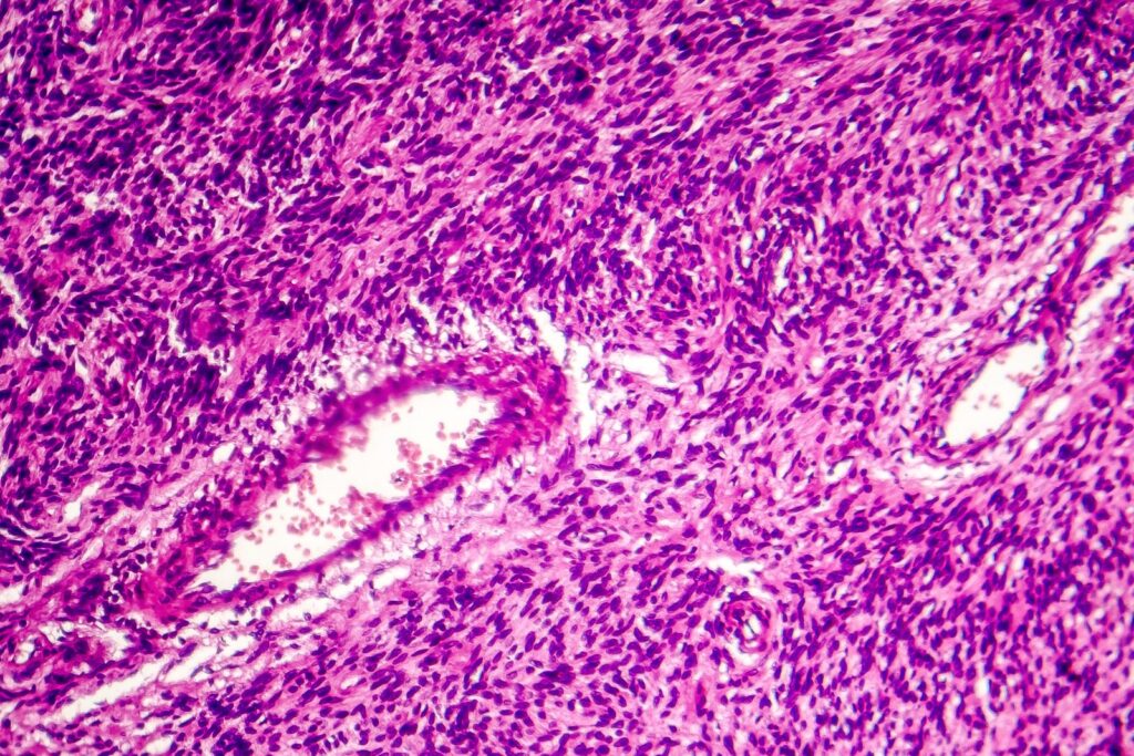 Tumore maligno fibroblasti fibrosarcoma